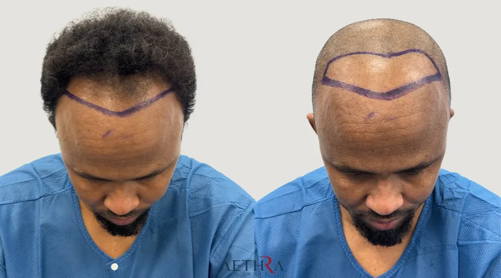 What Is Afro Hair Transplant