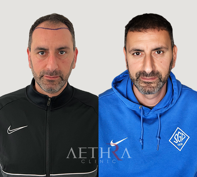 Before & After