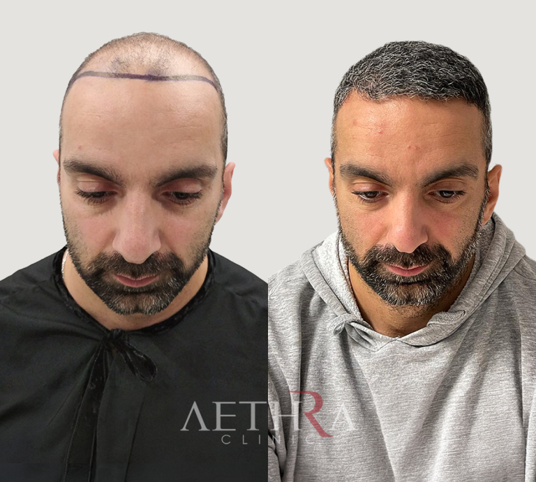 Before & After