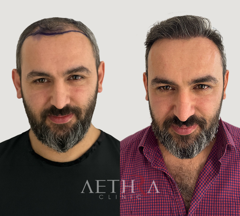 Before & After