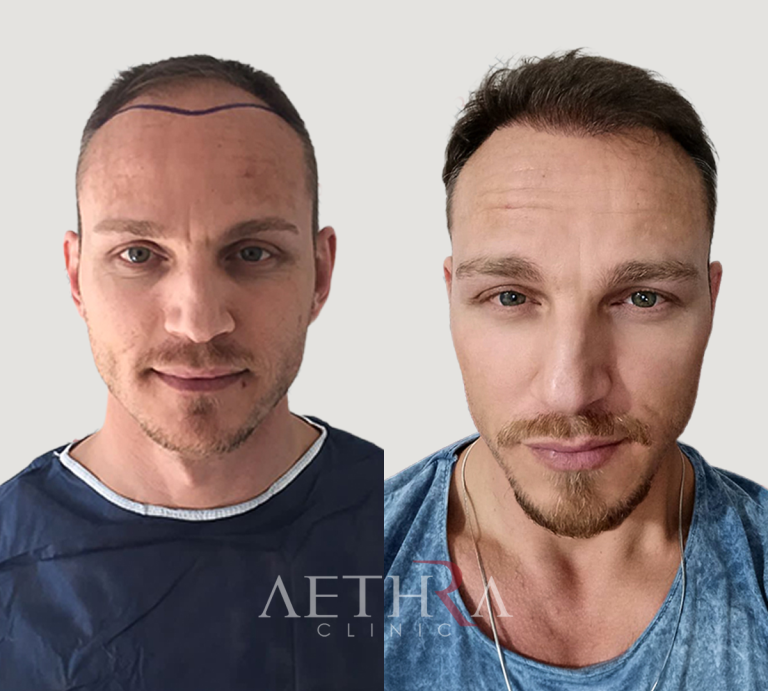 Before & After