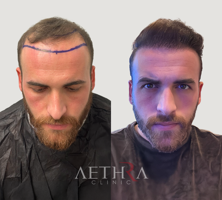 Before & After