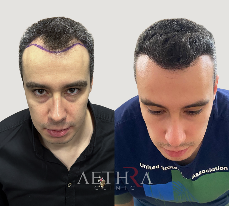 Before & After