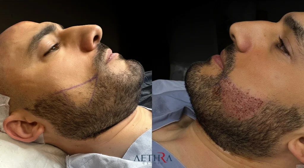 Beard Transplant Turkey