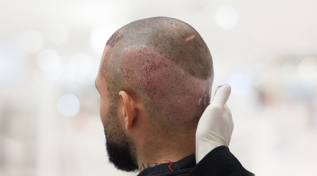 Hair Transplant Aftercare