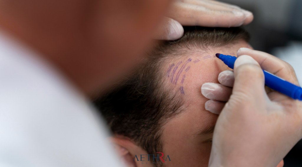 Natural Hairline Design in Hair Transplant